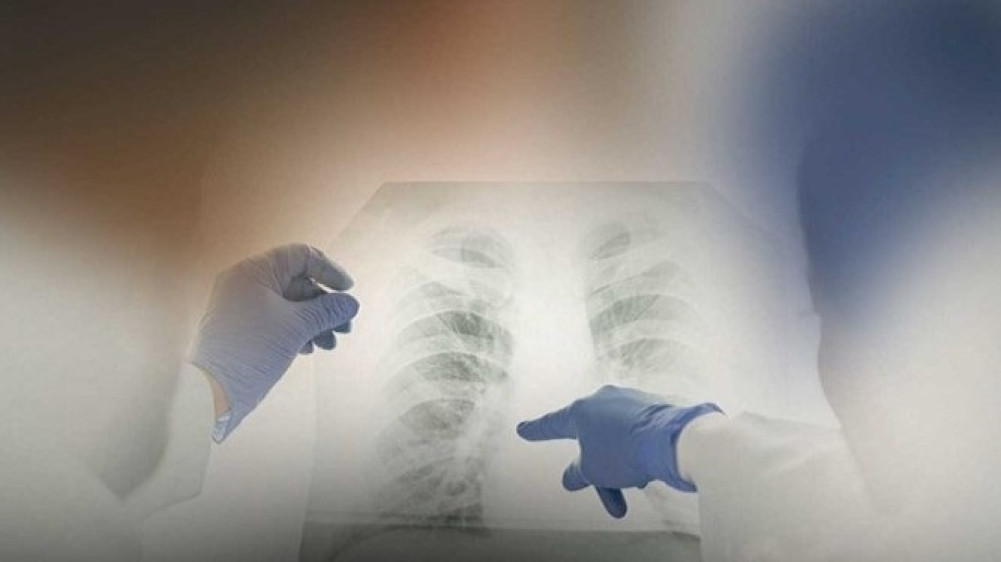 क्षयरोग र यसको व्यवस्थापनका लागि नेपालको प्रयास