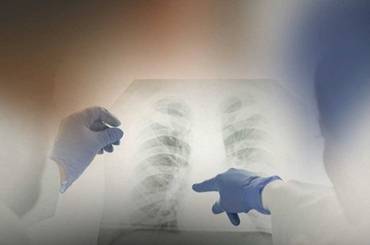 क्षयरोग र यसको व्यवस्थापनका लागि नेपालको प्रयास - img